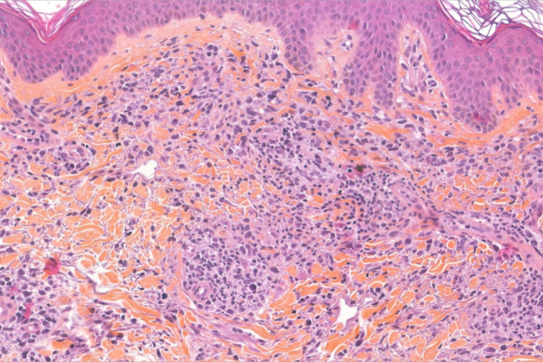 lame_digitalisee_biopsie_lymphome_T